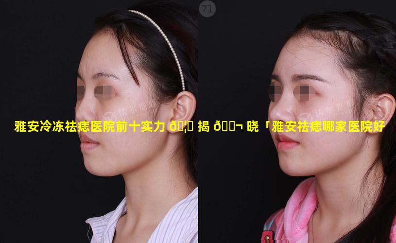 雅安冷冻祛痣医院前十实力 🦈 揭 🐬 晓「雅安祛痣哪家医院好」